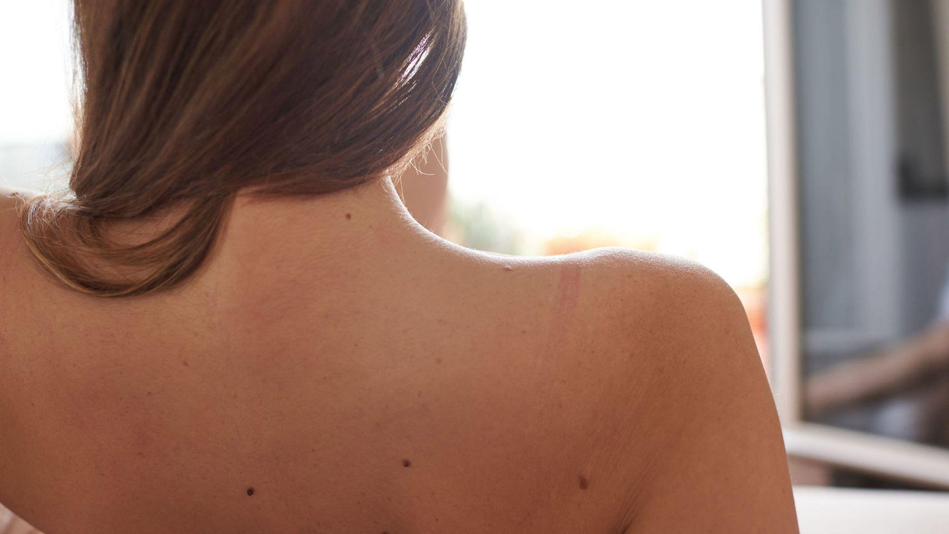 Hautkrebs-Screening: Nackter Rücken einer Frau. 
