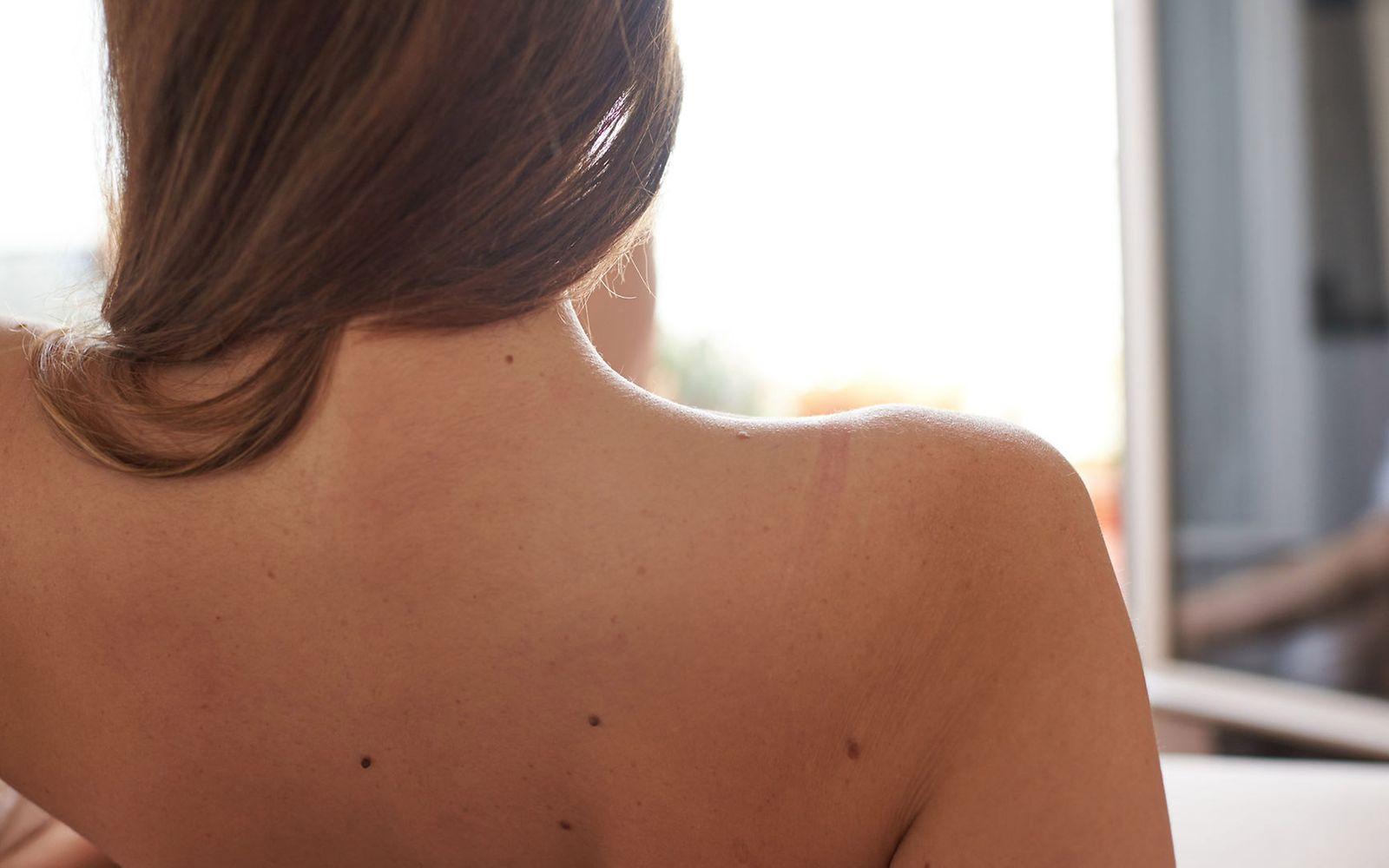 Hautkrebs-Screening: Nackter Rücken einer Frau. 