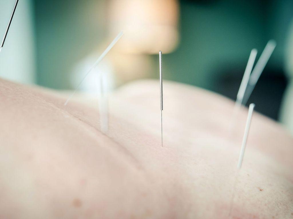 Akupunktur: Nadeln werden zur Behandlung in Haut gesteckt