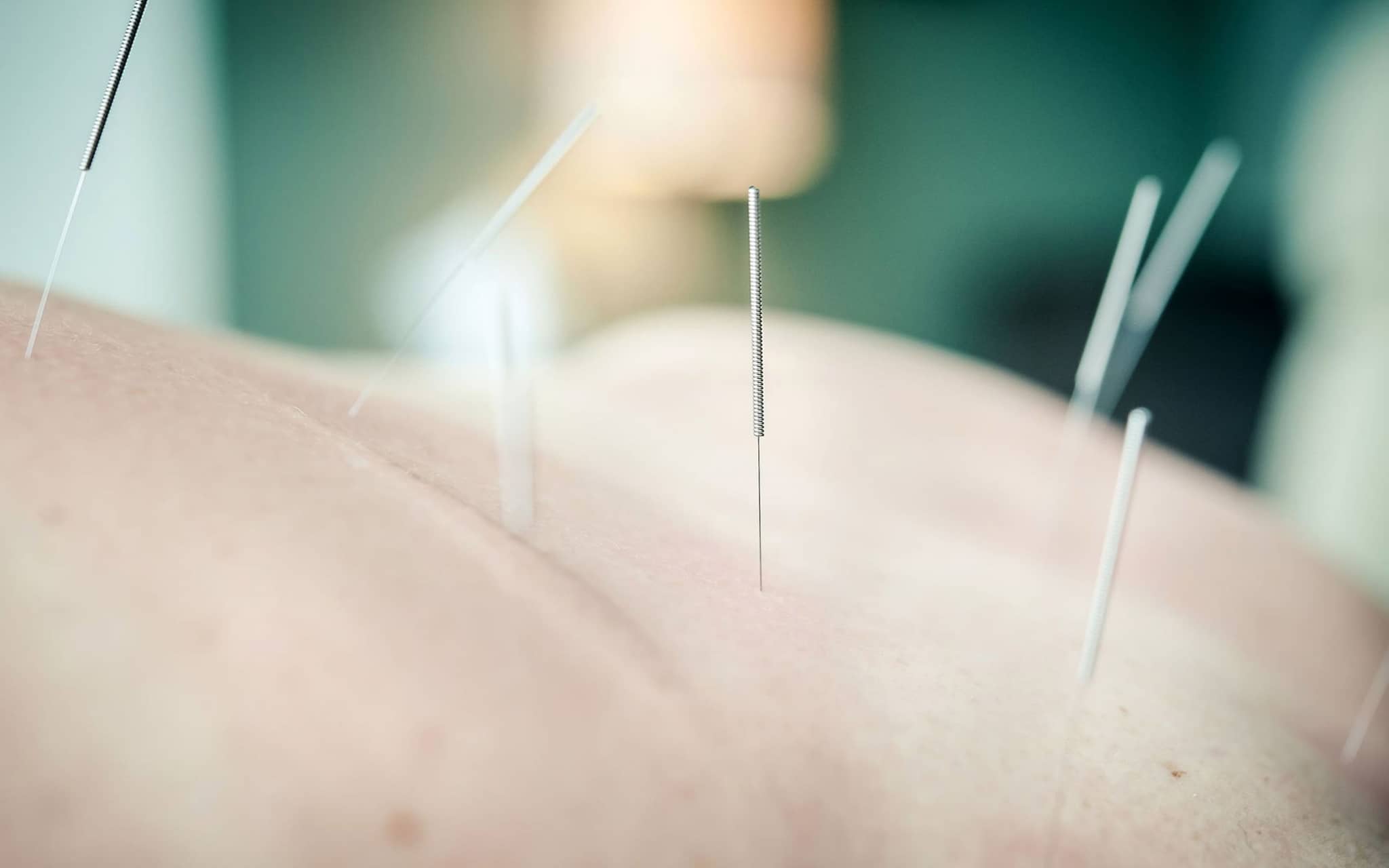 Akupunktur: Nadeln werden zur Behandlung in Haut gesteckt