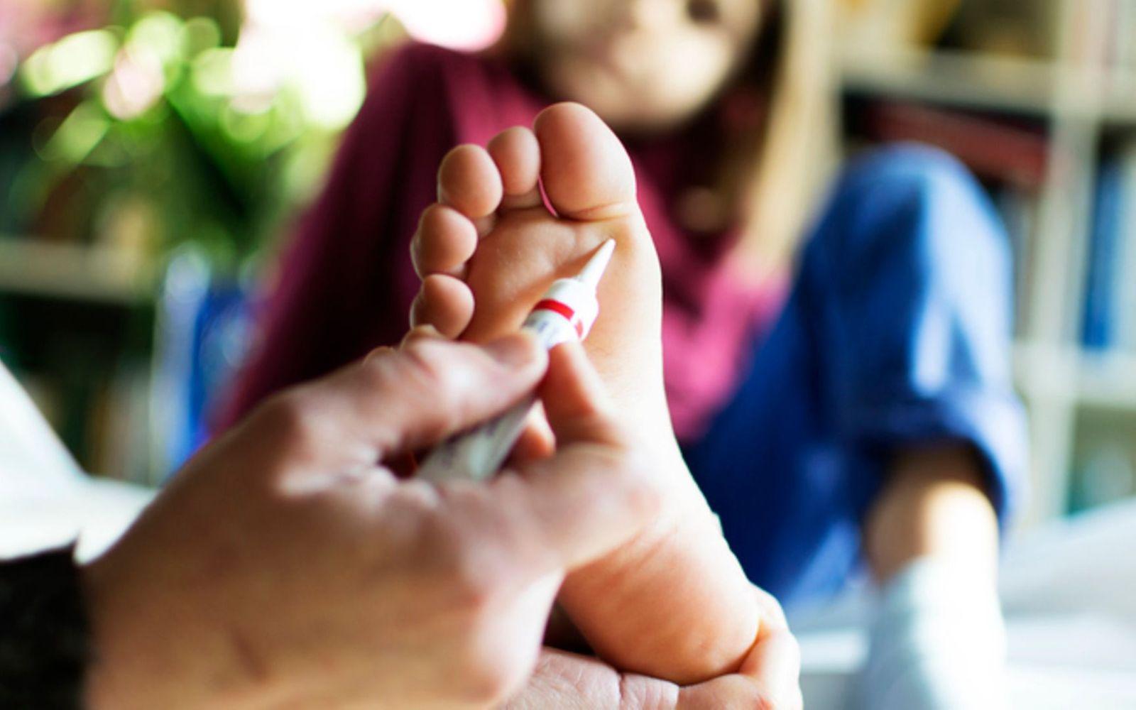 Warzen bei Kindern: ein Elternteil trägt ein Warzenmittel auf die Fußsohle des Kindes auf