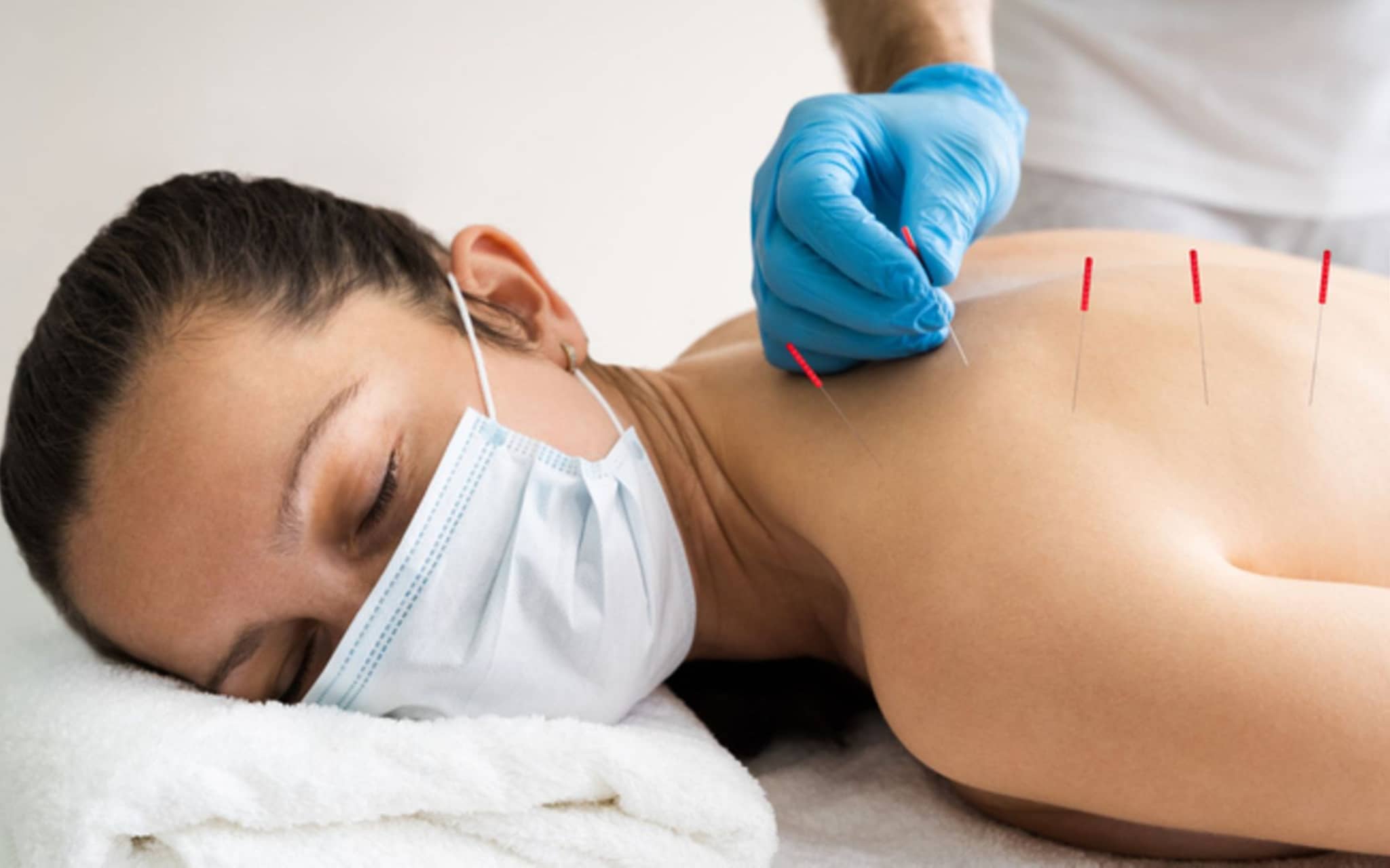 abbildung-akupunktur-7-2473510.2