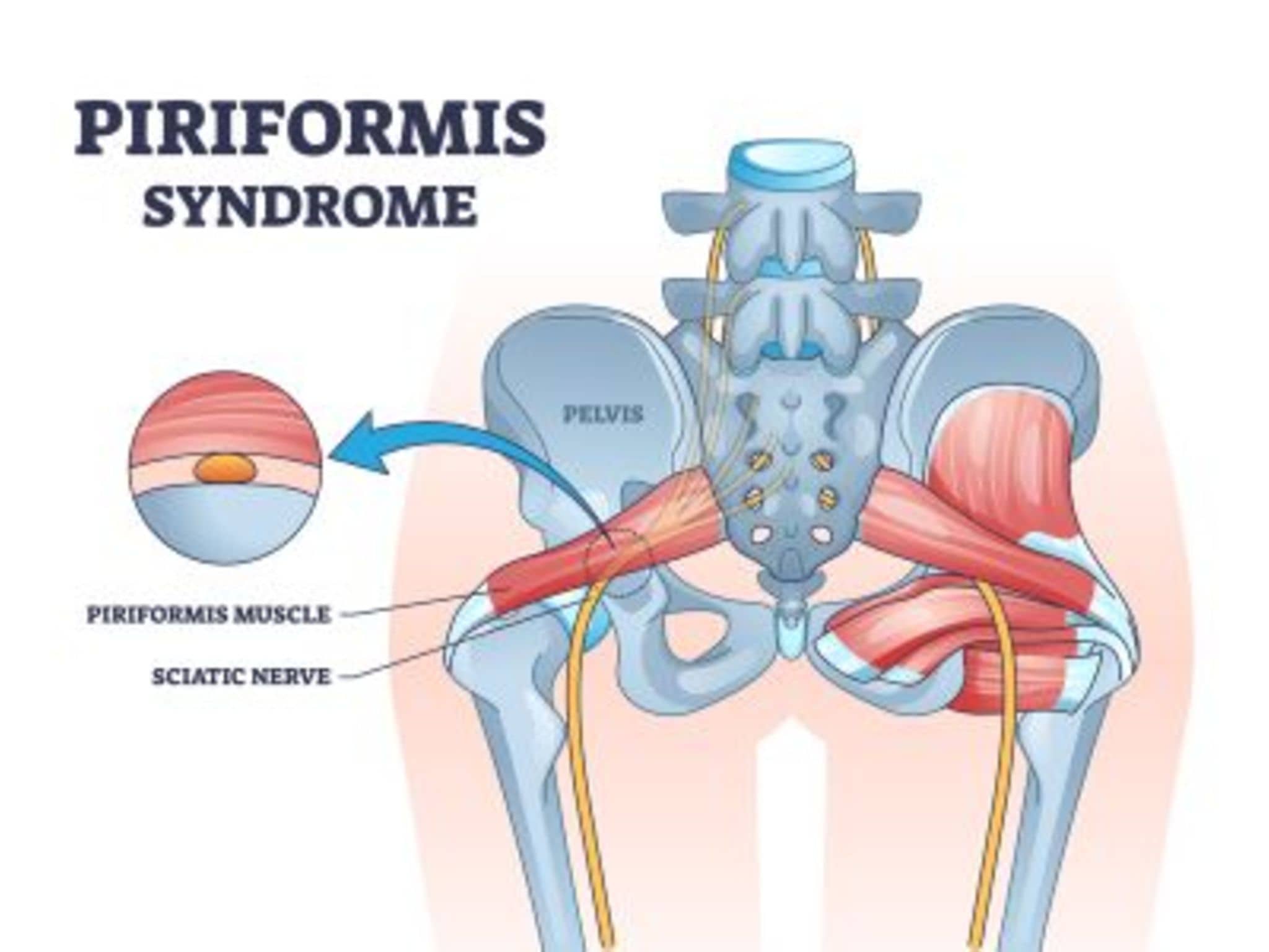 Graphik Piriformis-Syndrom