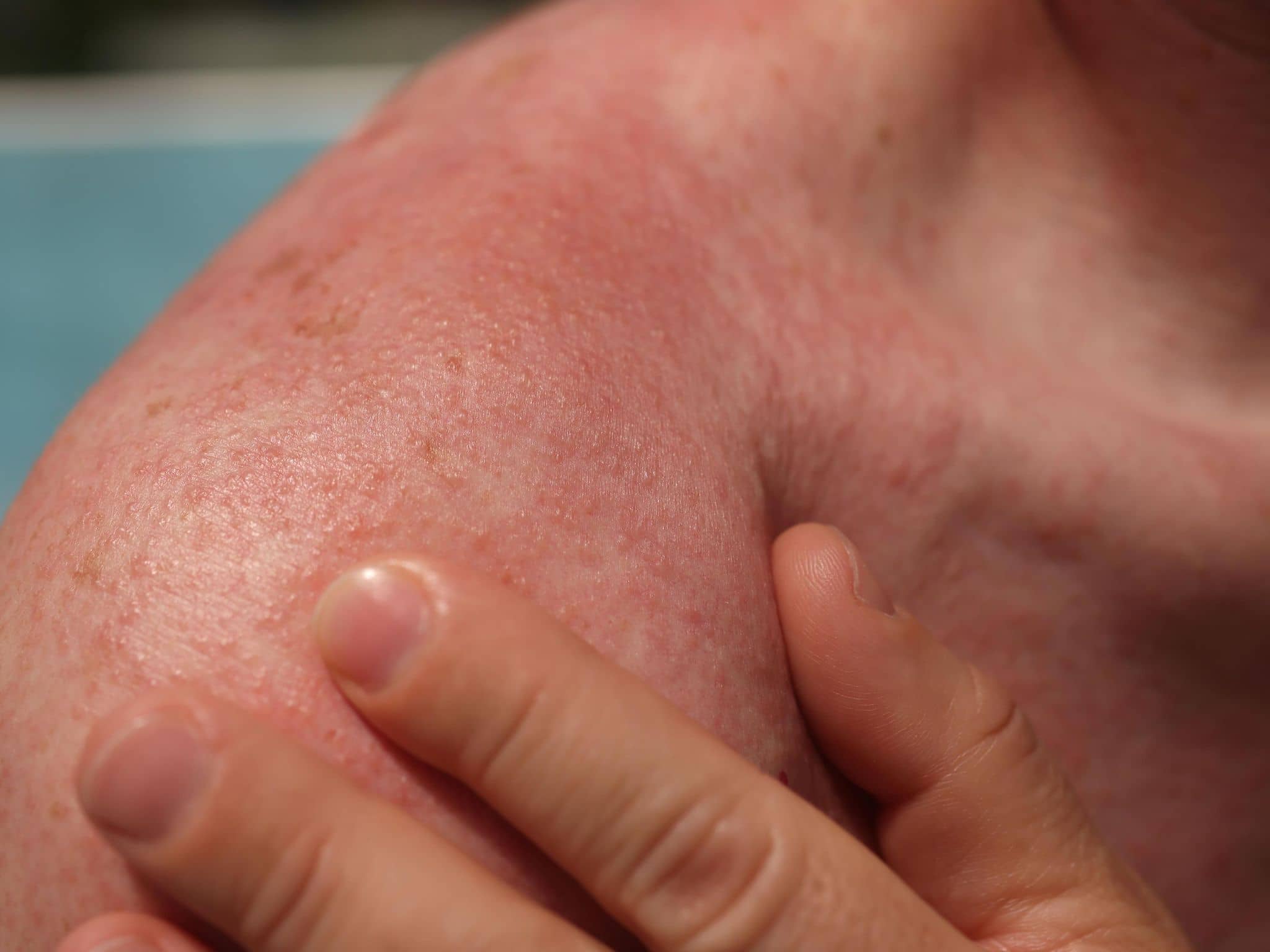 Eine Schulter mit typischen Ausschlag der Sonnenallergie