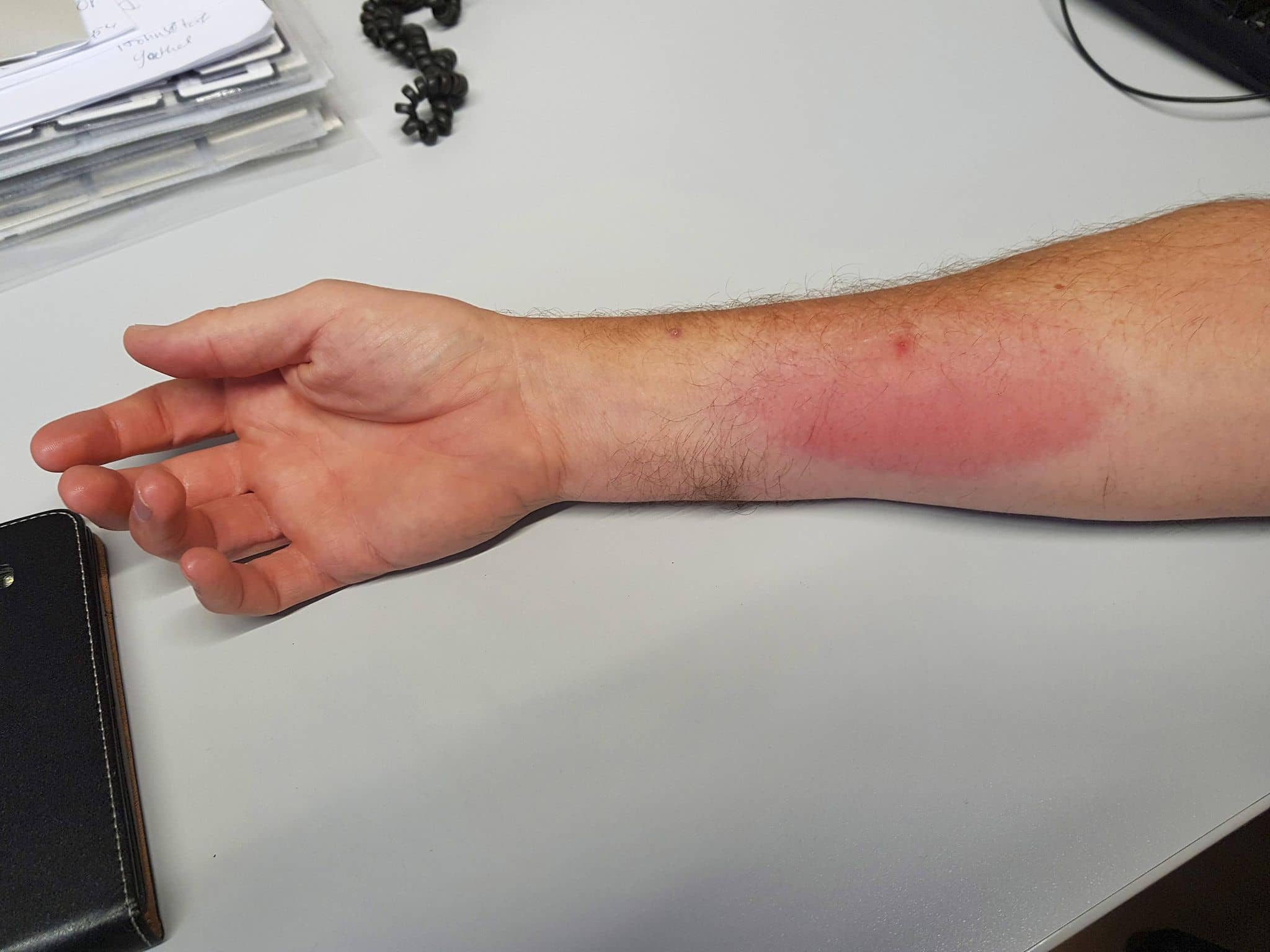 Arm mit entzündetem Bremsenstich