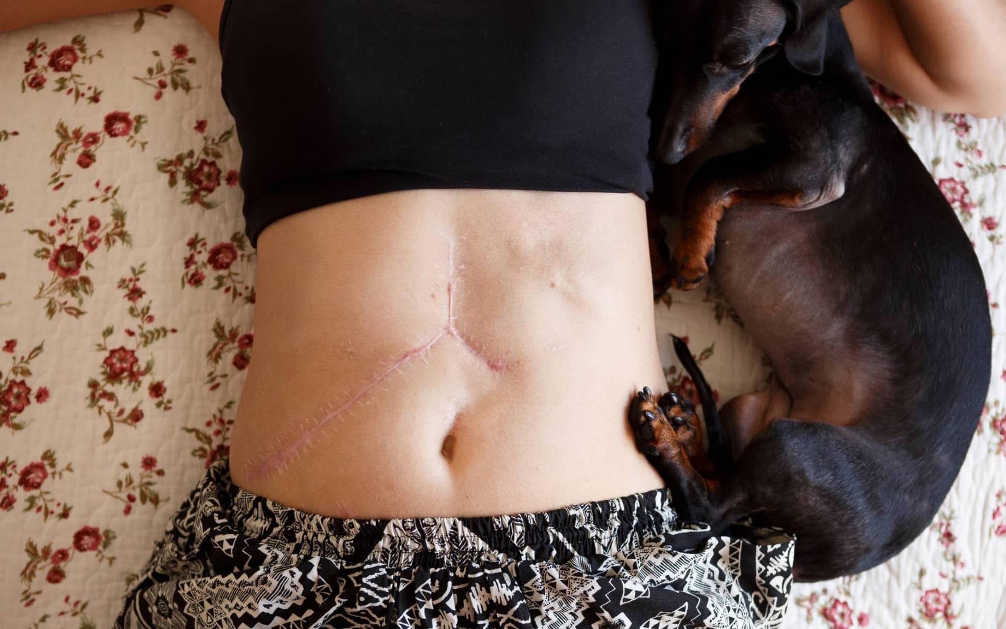 Organspende: Bauch einer Frau mit Operationsnarbe