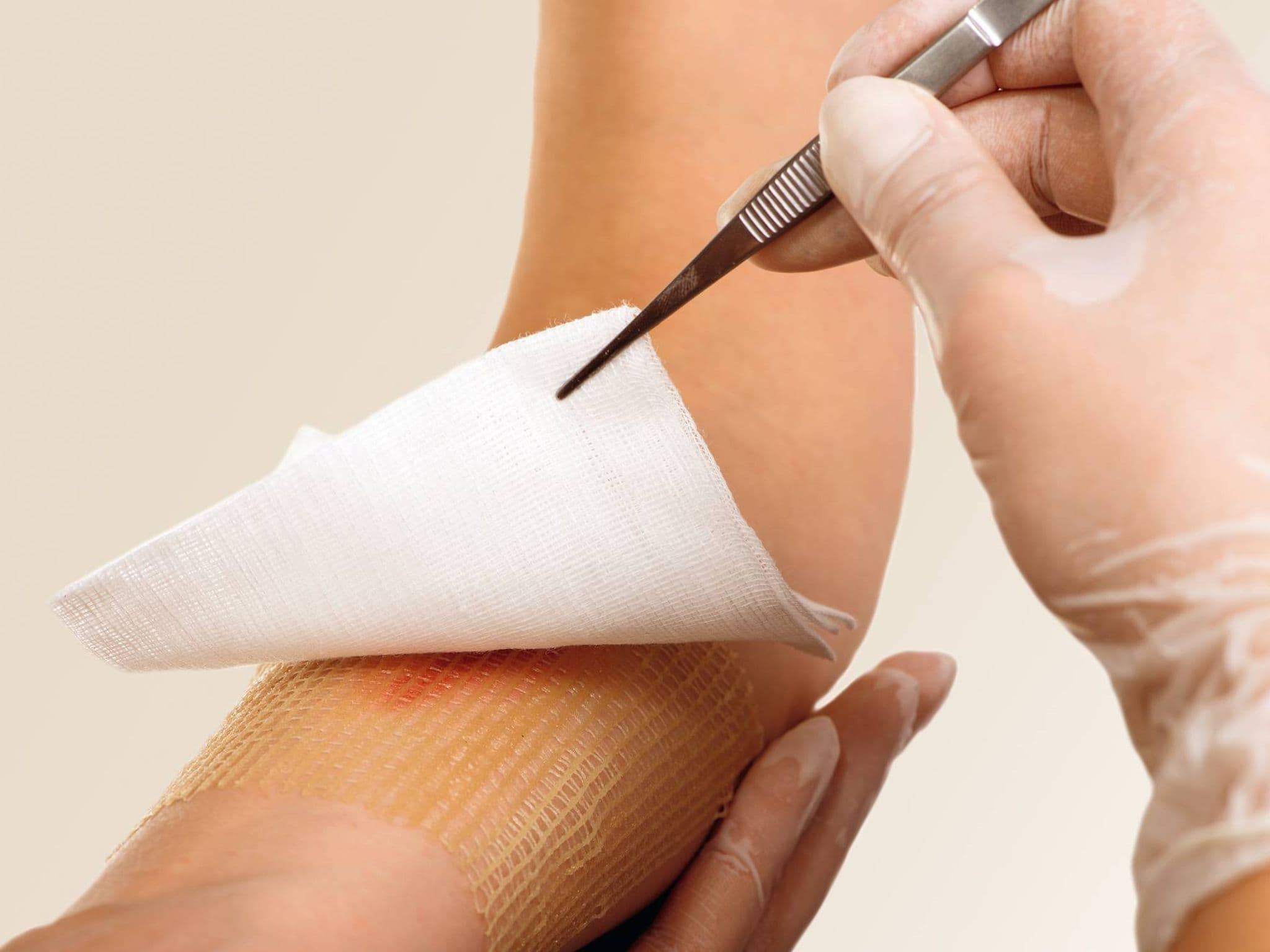 Bild: Mullbinde wird mit einer Pinzette angehoben, die auf einer Gaze liegt.