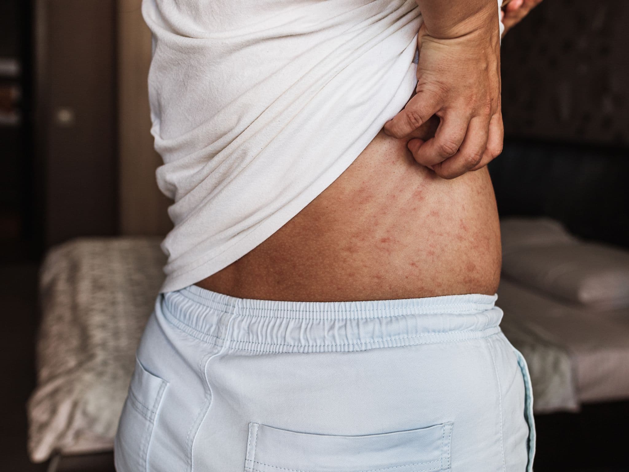 Bild: Frau hebt ihr T-Shirt um sich am Rücken zu kratzen.